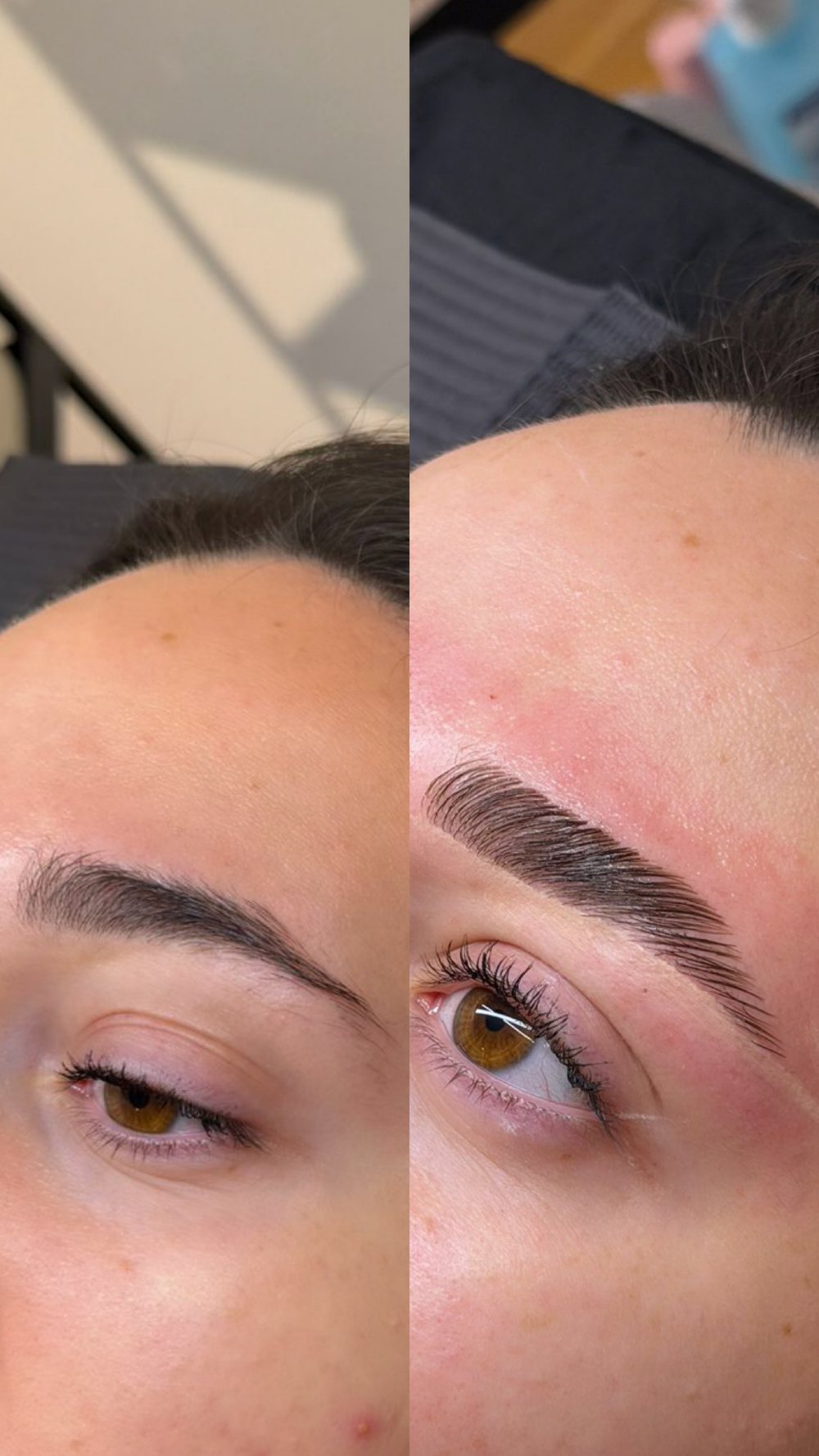 Brow Lifting vorher und nachher